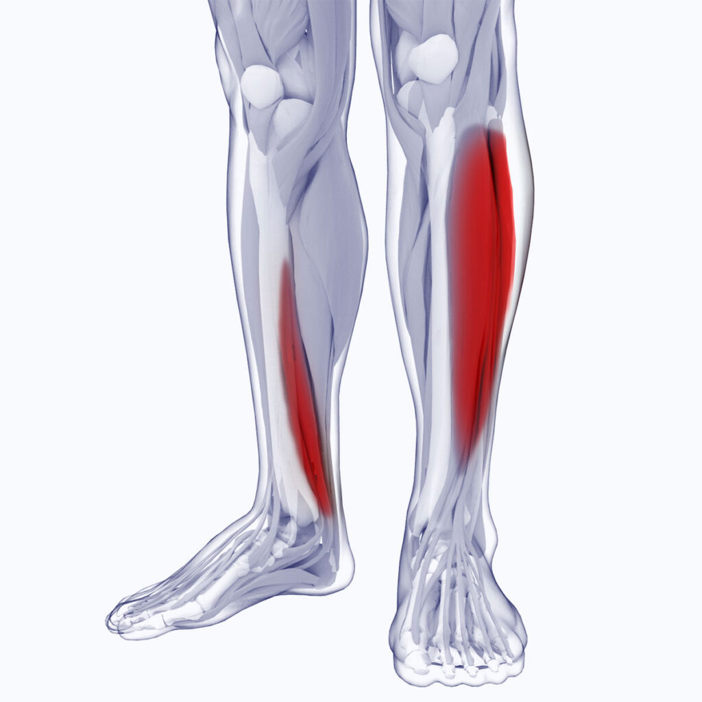 Shin Splints - Motus Physical Therapy