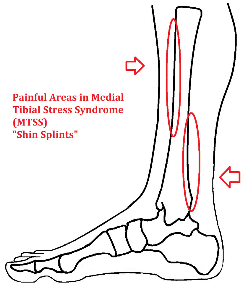 Shin Splints, Shin Pain & and its Symptoms