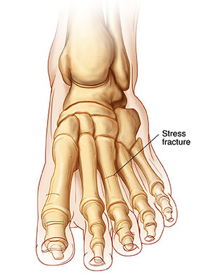 What is a Stress Fracture of the Tibia amp How to Address It - Upswing Health