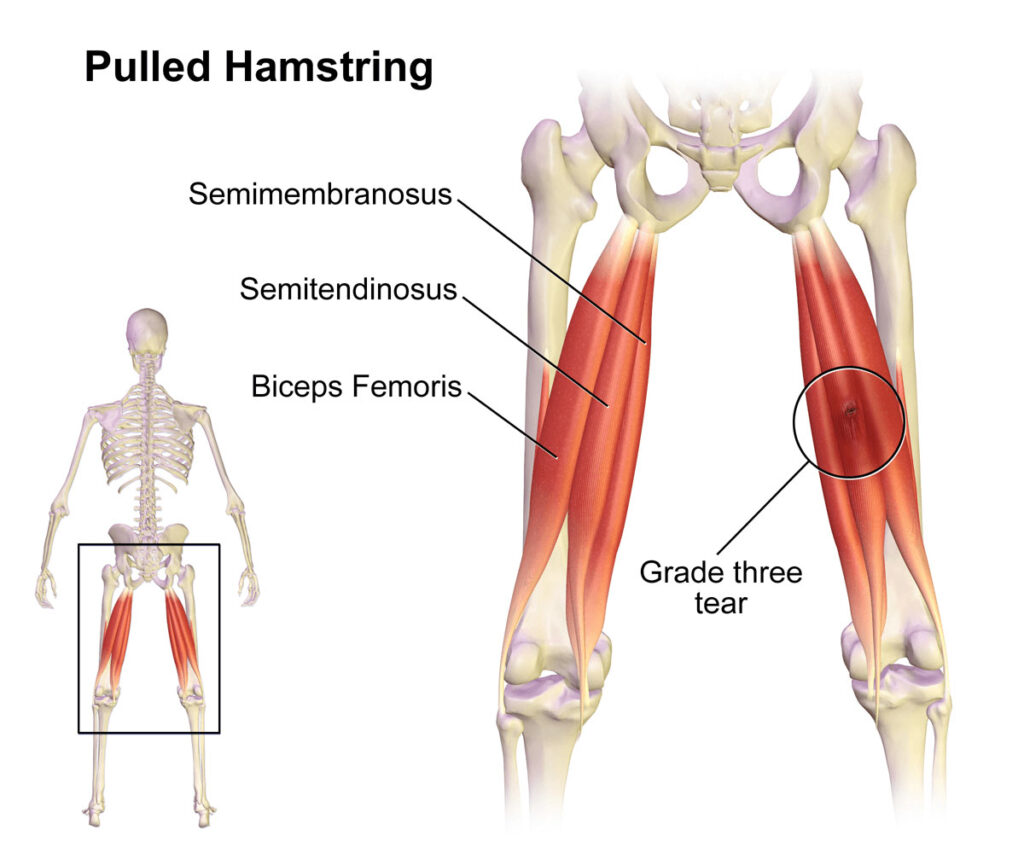 Hamstring Injury - Motus Physical Therapy