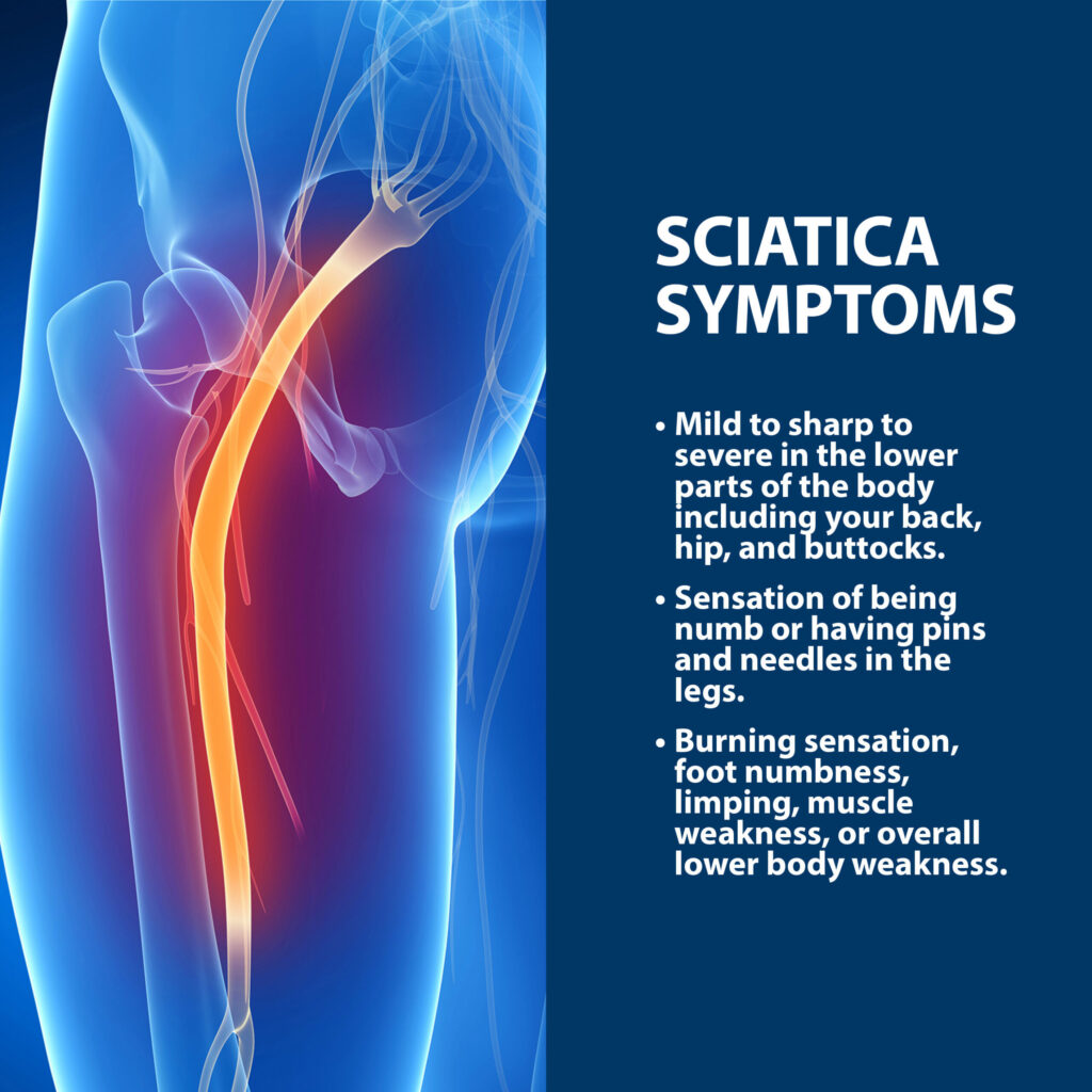 Why You Need Professional Pain Management for Your Sciatica