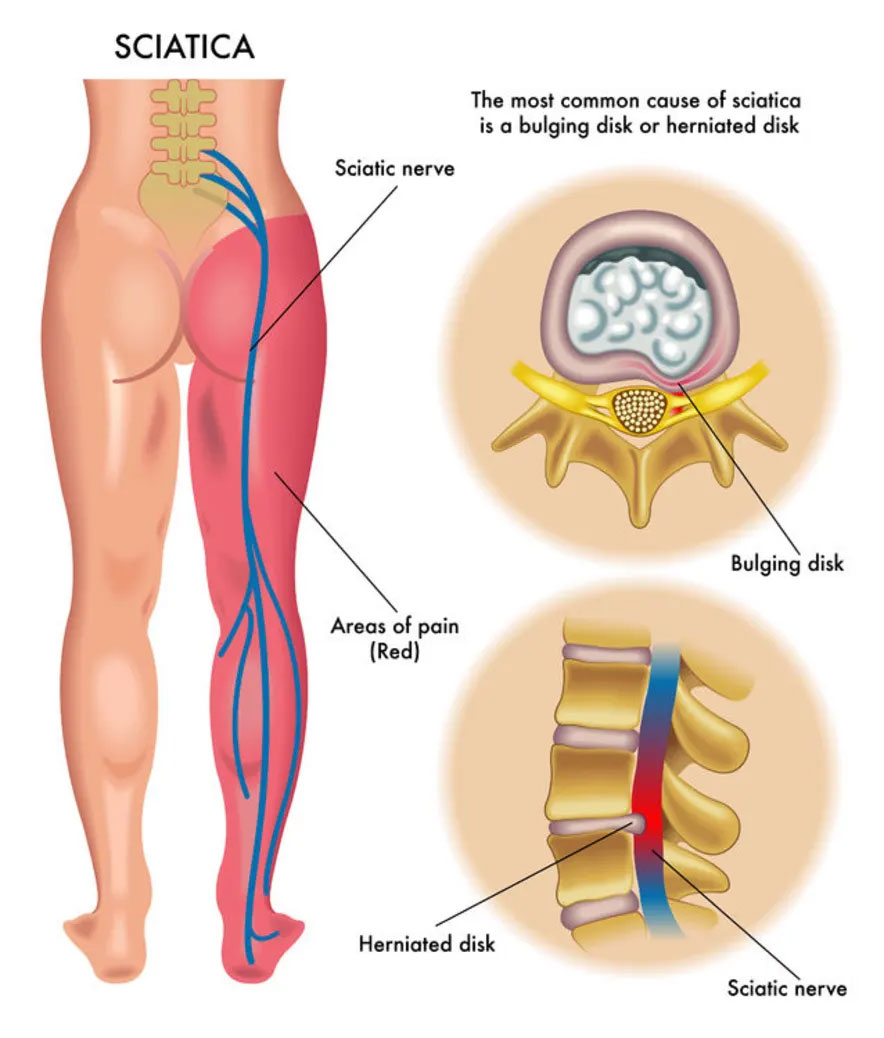 Tips For Relieving Sciatica Pain - Innovative PT