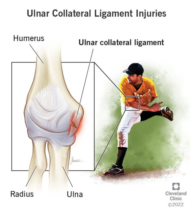 Tommy John Surgery (UCL Injury) - Motus Physical Therapy