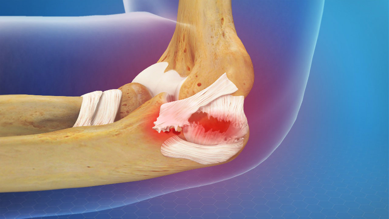 Tommy John Surgery (UCL Injury) - Motus Physical Therapy