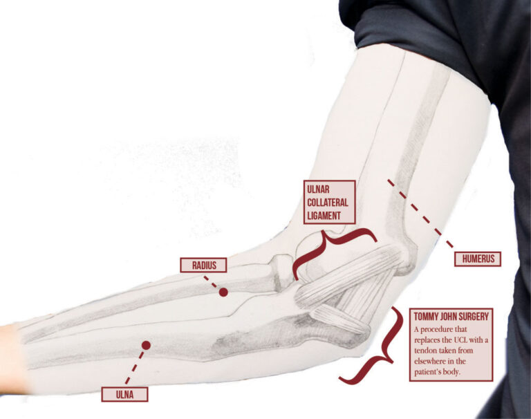 Tommy John Surgery (UCL Injury) - Motus Physical Therapy