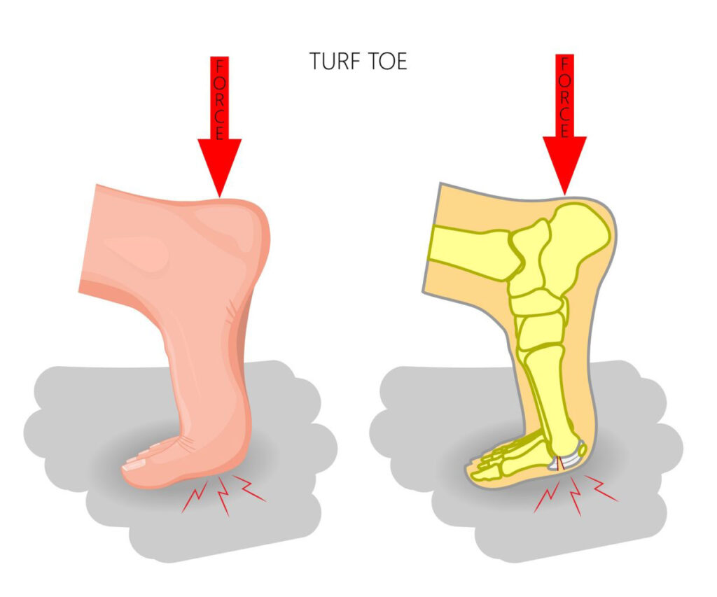 Turf Toe Exercises for Pain & Injury Prevention - Vive Health