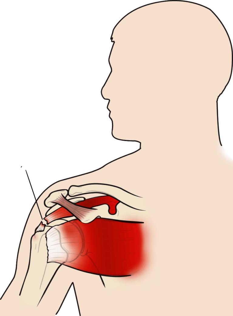 Rotator Cuff Tear Motus Physical Therapy