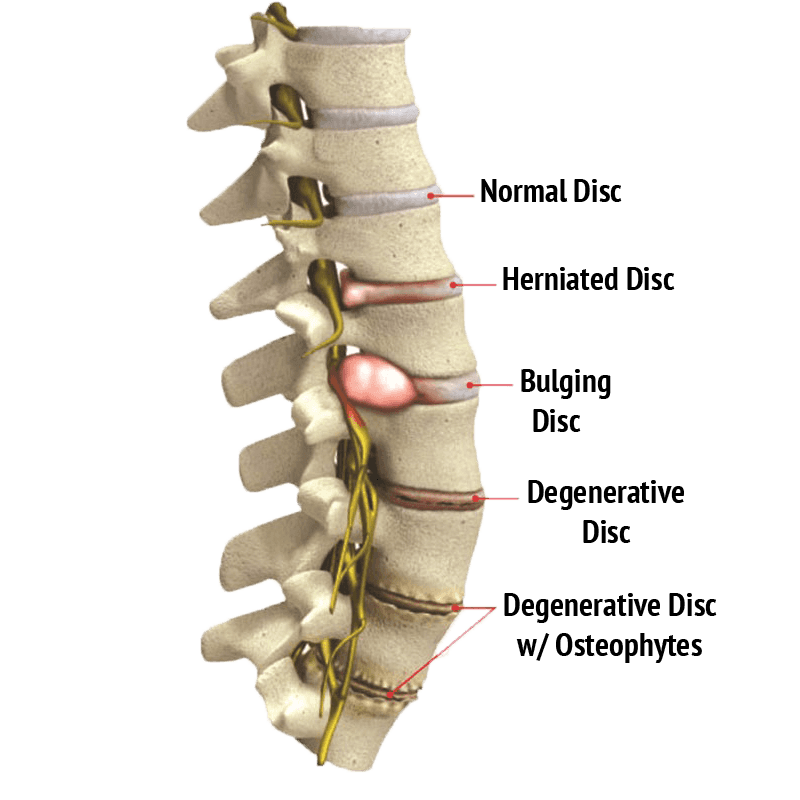 What is Lumbar Spine Degenerative Disc Disease & How to Manage