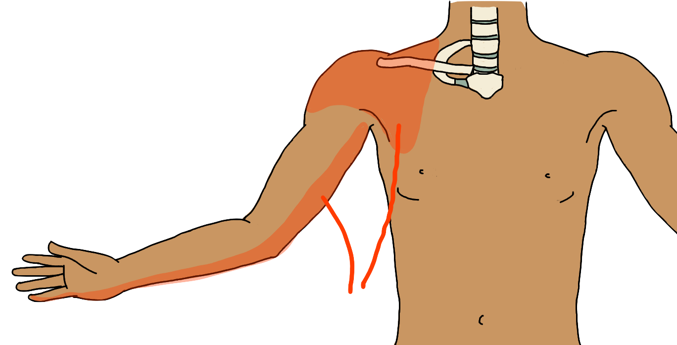 Thoracic Outlet Syndrome (TOS)