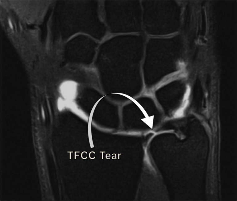 Triangular Fibrocartilage Complex Injury (TFCC) - Motus Physical Therapy