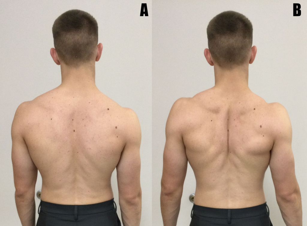 What Is Scapular Winging and How to Handle the Condition