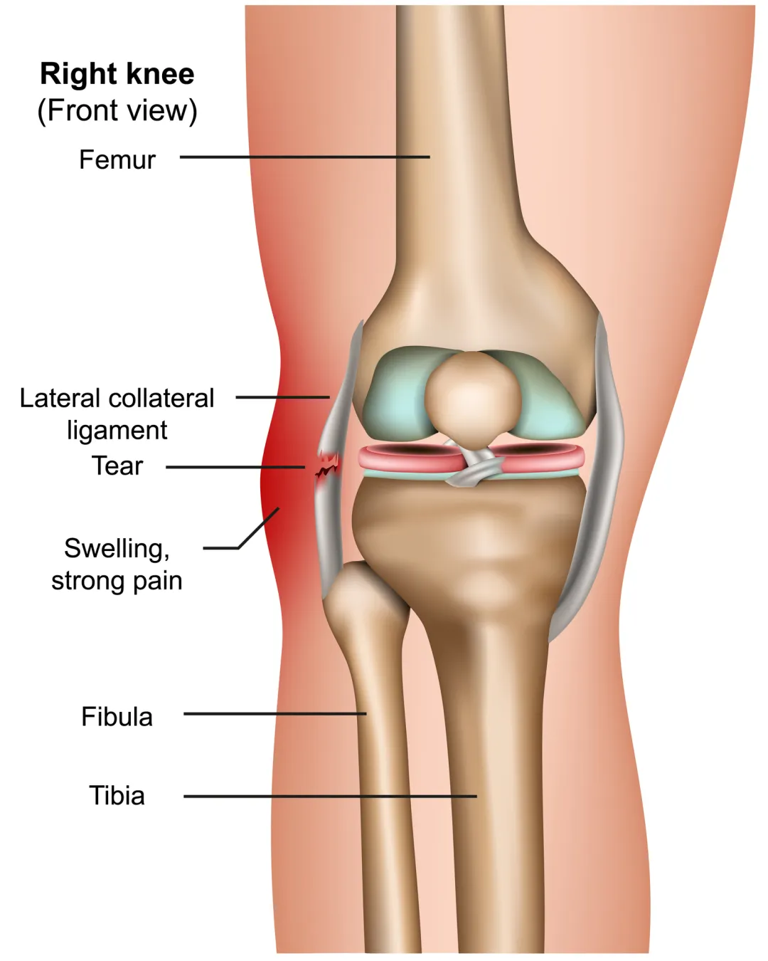 fibular collateral ligament tear