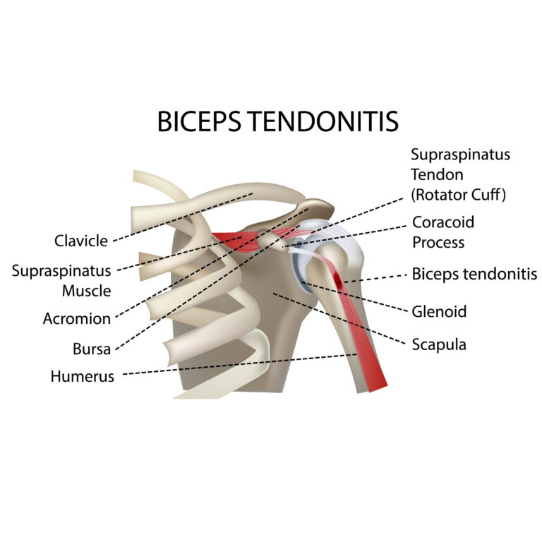 Biceps Tendonitis - Motus Physical Therapy