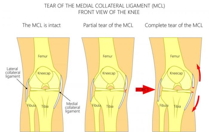 MCL Injury - Motus Physical Therapy