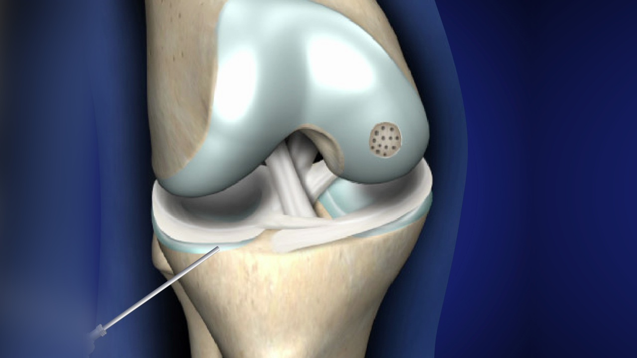 Microfracture Surgery - Motus Physical Therapy