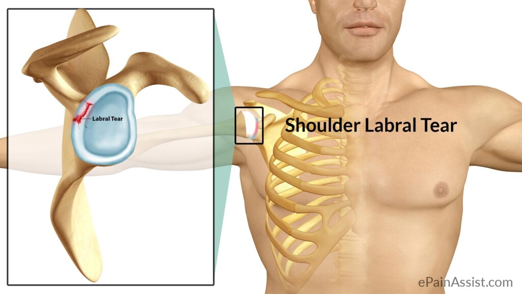 Torn Shoulder Labrum: Causes, Symptoms, Treatment, Recovery