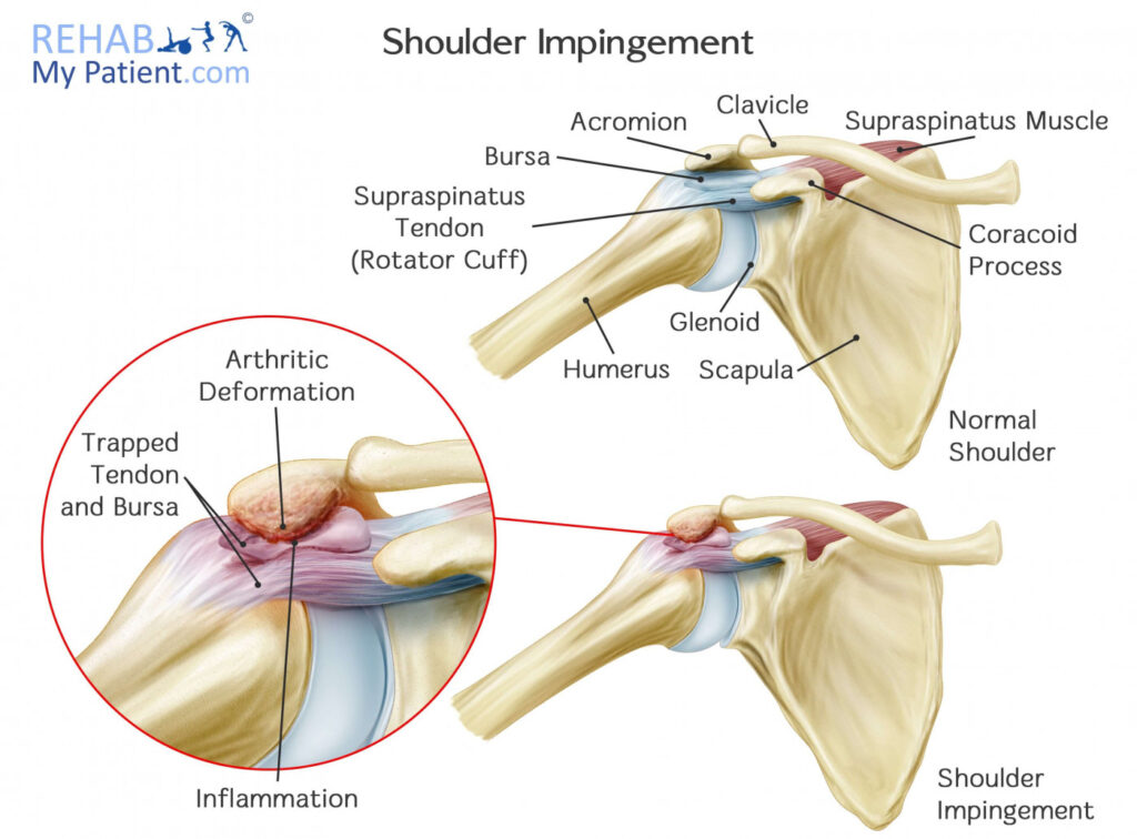 Shoulder Impingement Motus Physical Therapy