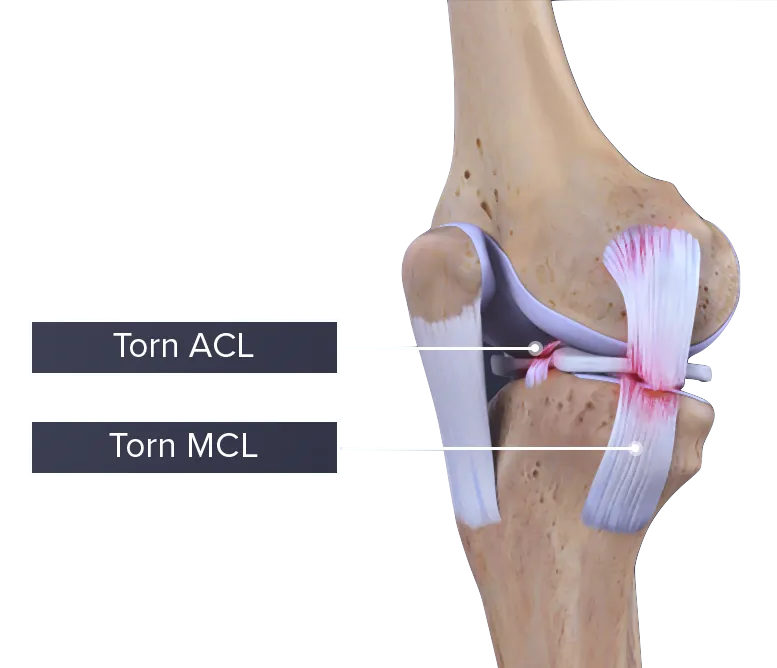 MCL Tear - Relieve Foot Pain & Leg Pain