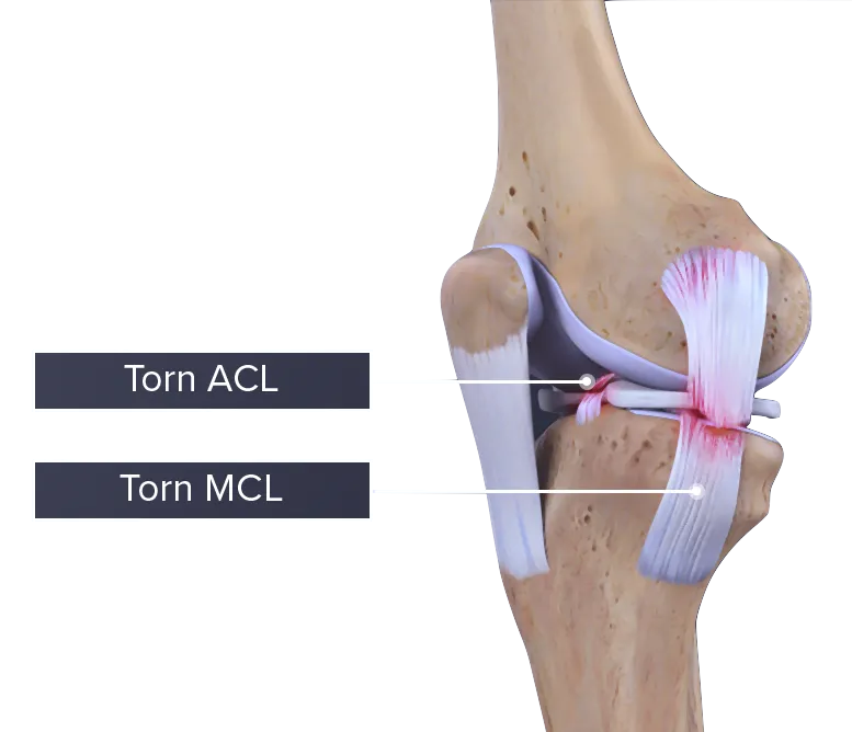 Symptoms of MCL Sprains and Tears