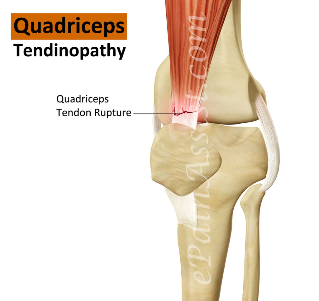 Quadriceps Tendon Pain Symptoms