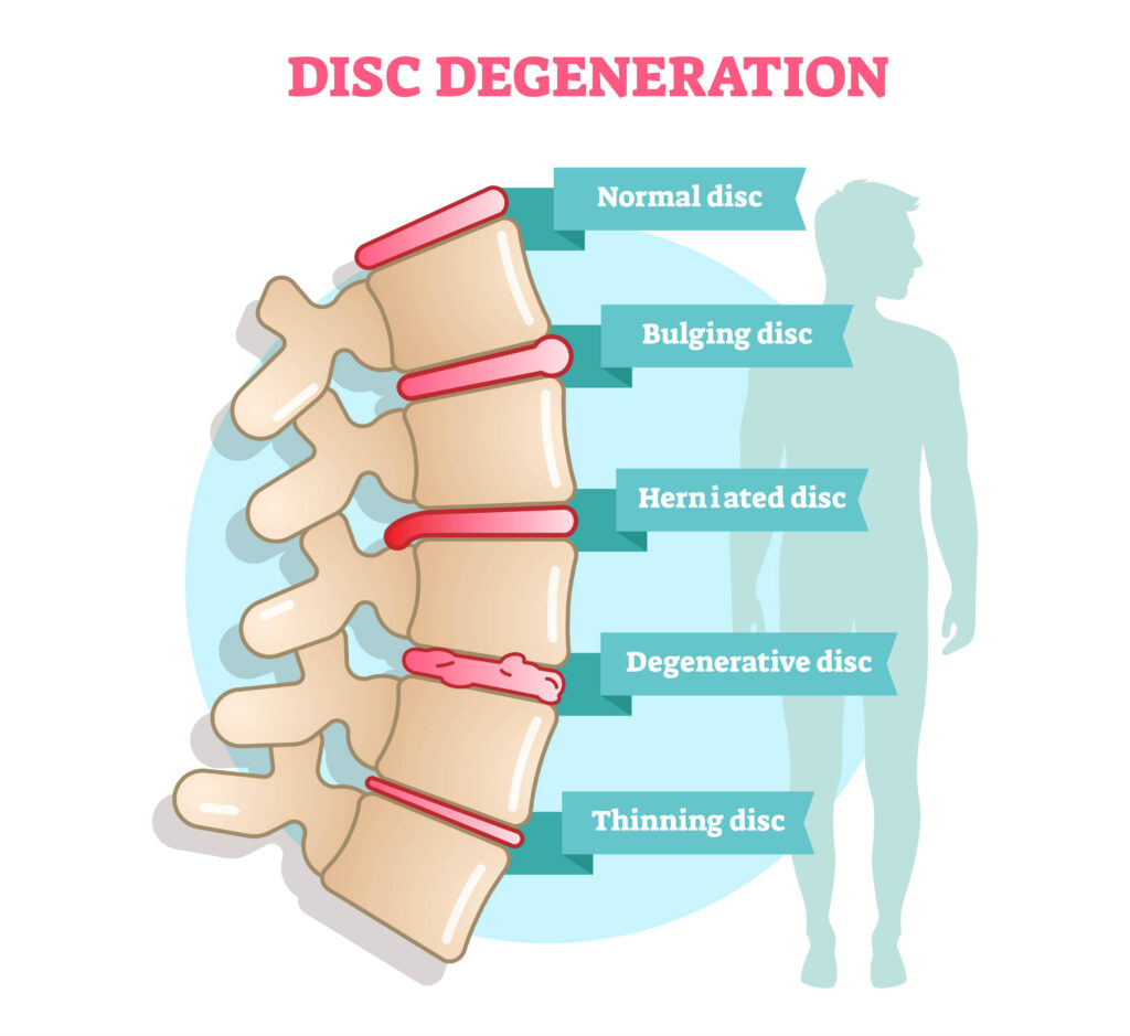 The Effects Of Physiotherapy On A Herniated Disc