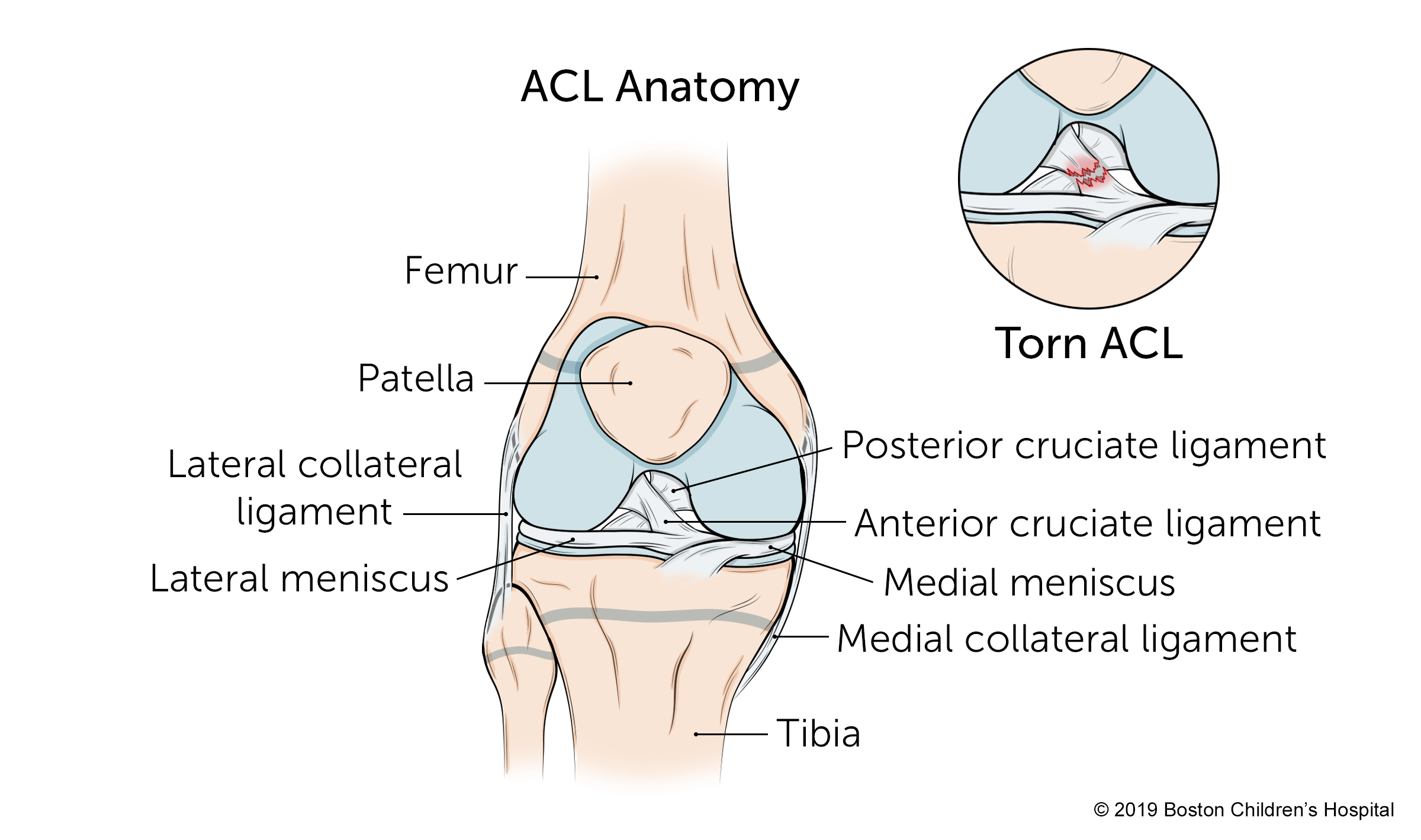 ACL (Anterior Cruciate Ligament) MCL (Medial Collateral Ligament) Tear and  Repair - 3D Animation 