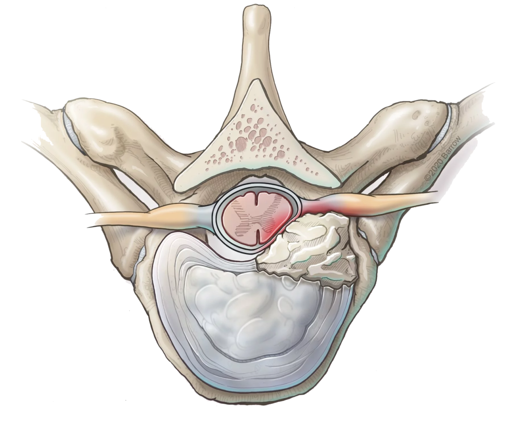 Cervical Herniated Disk - UF Health