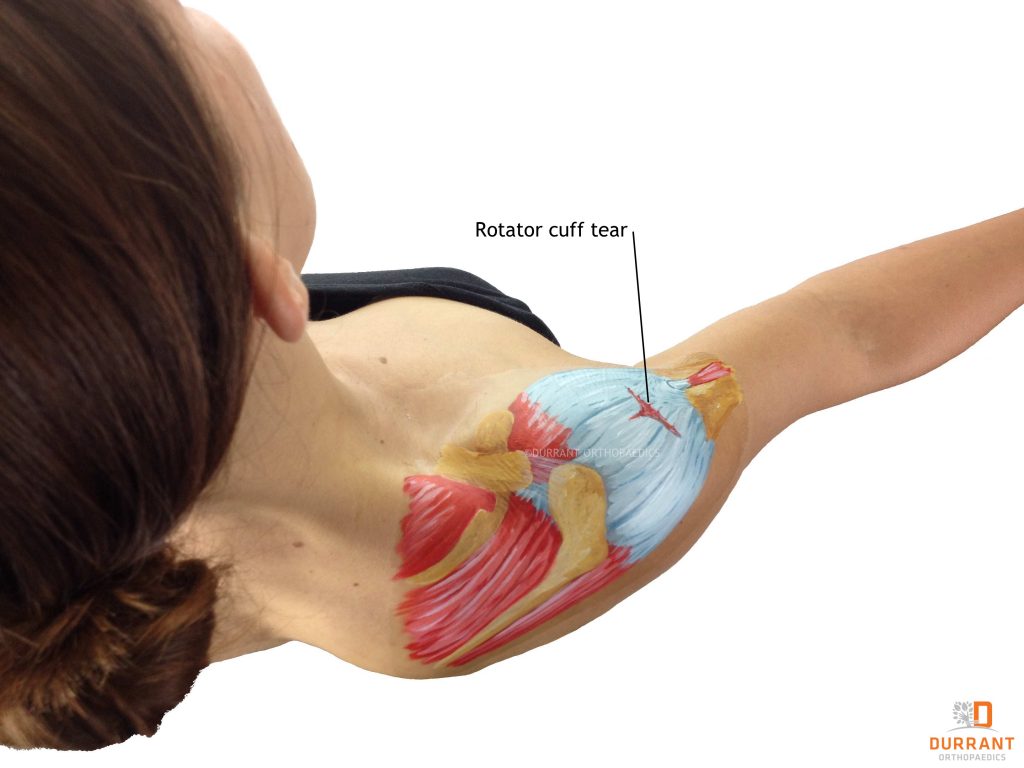 Physical Therapy in our clinic for Shoulder - Rotator Cuff Tears