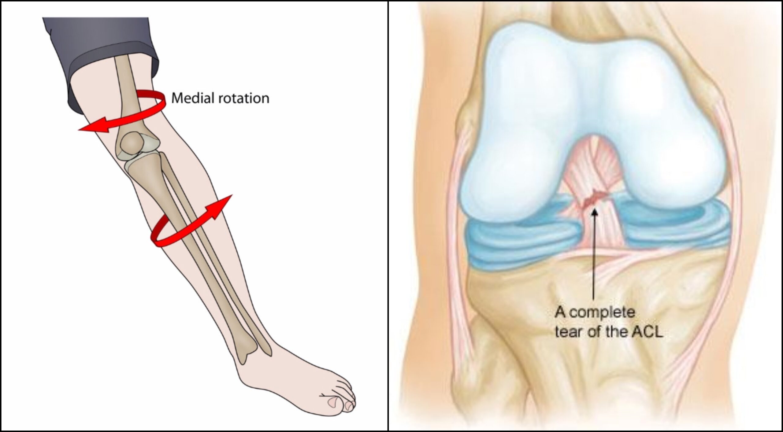 ACL Tear, ACL Injuries Symptoms & Signs