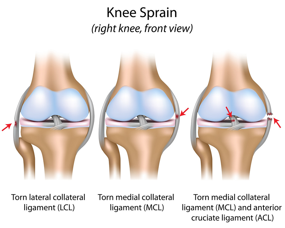 Medial Collateral Ligament (MCL) Injuries – Core EM