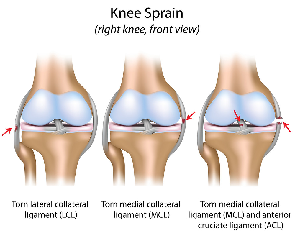 Front View Of Knee Showing Torn Medial Photograph By Elise, 56% OFF