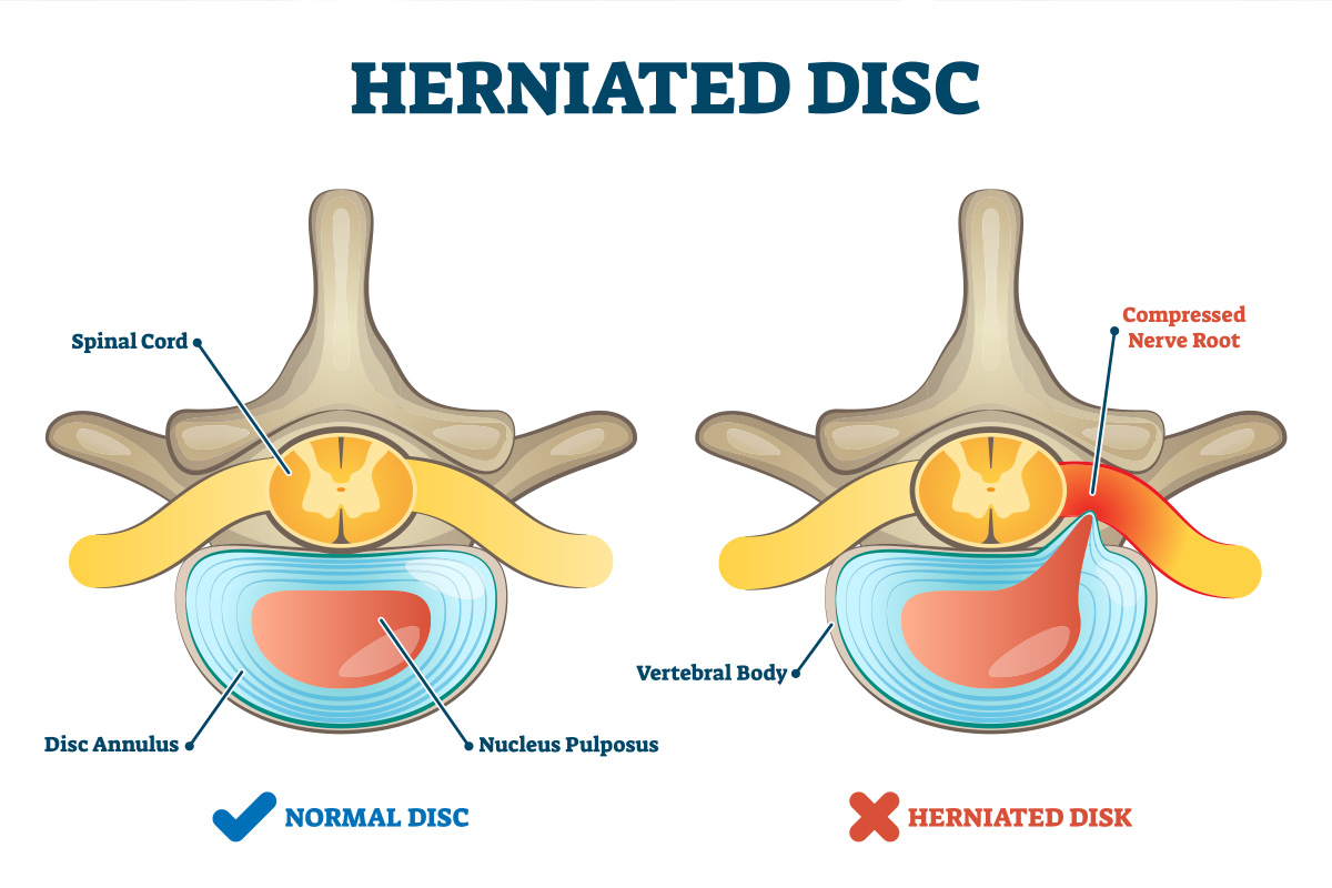 Cervical Herniated Disk - UF Health