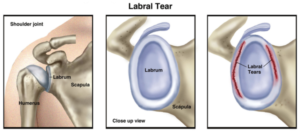 Shoulder Labral Tear Motus Physical Therapy