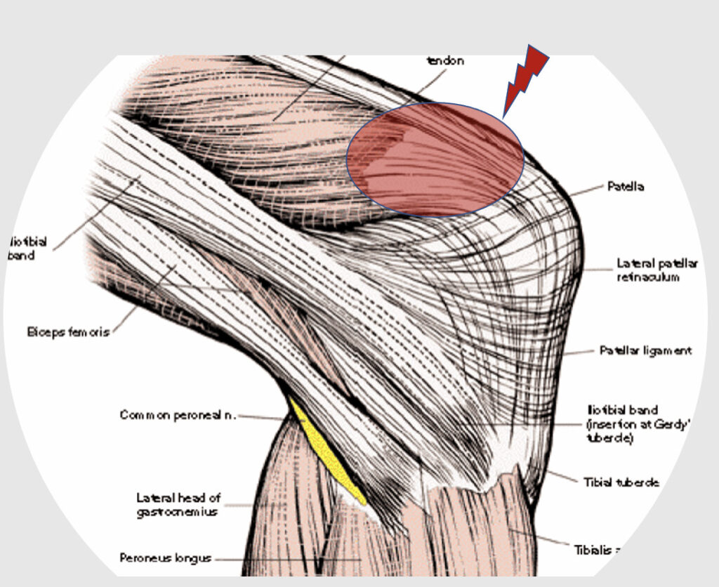 Patellar Tendon/ Quad Tendon Tear - Motus Physical Therapy