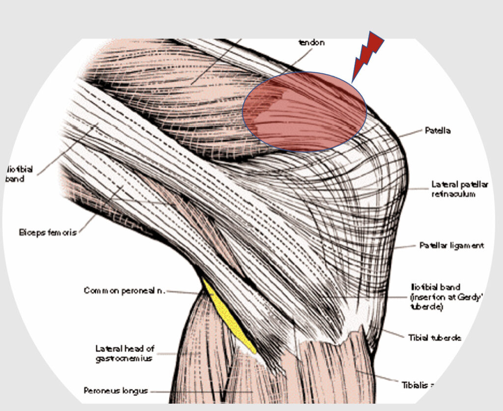 Patella Tendon Rupture Evaluation 