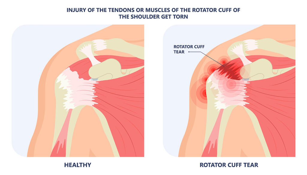 Rotator Cuff Tear - Motus Physical Therapy