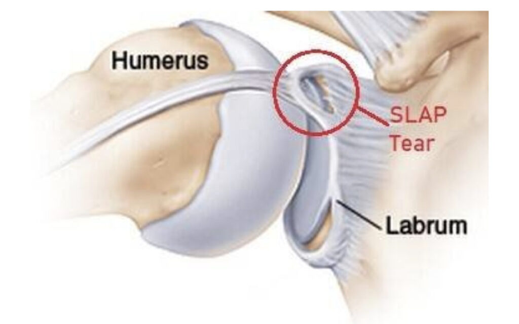 Torn Shoulder Labrum: Causes, Symptoms, Treatment, Recovery