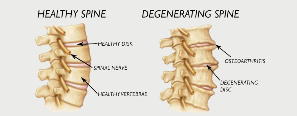 lumbar-spine-degeneration