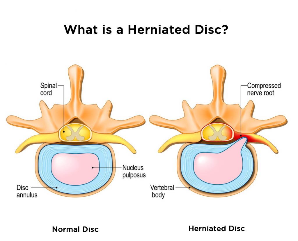 Lumbar Herniated Disc Treatment Video