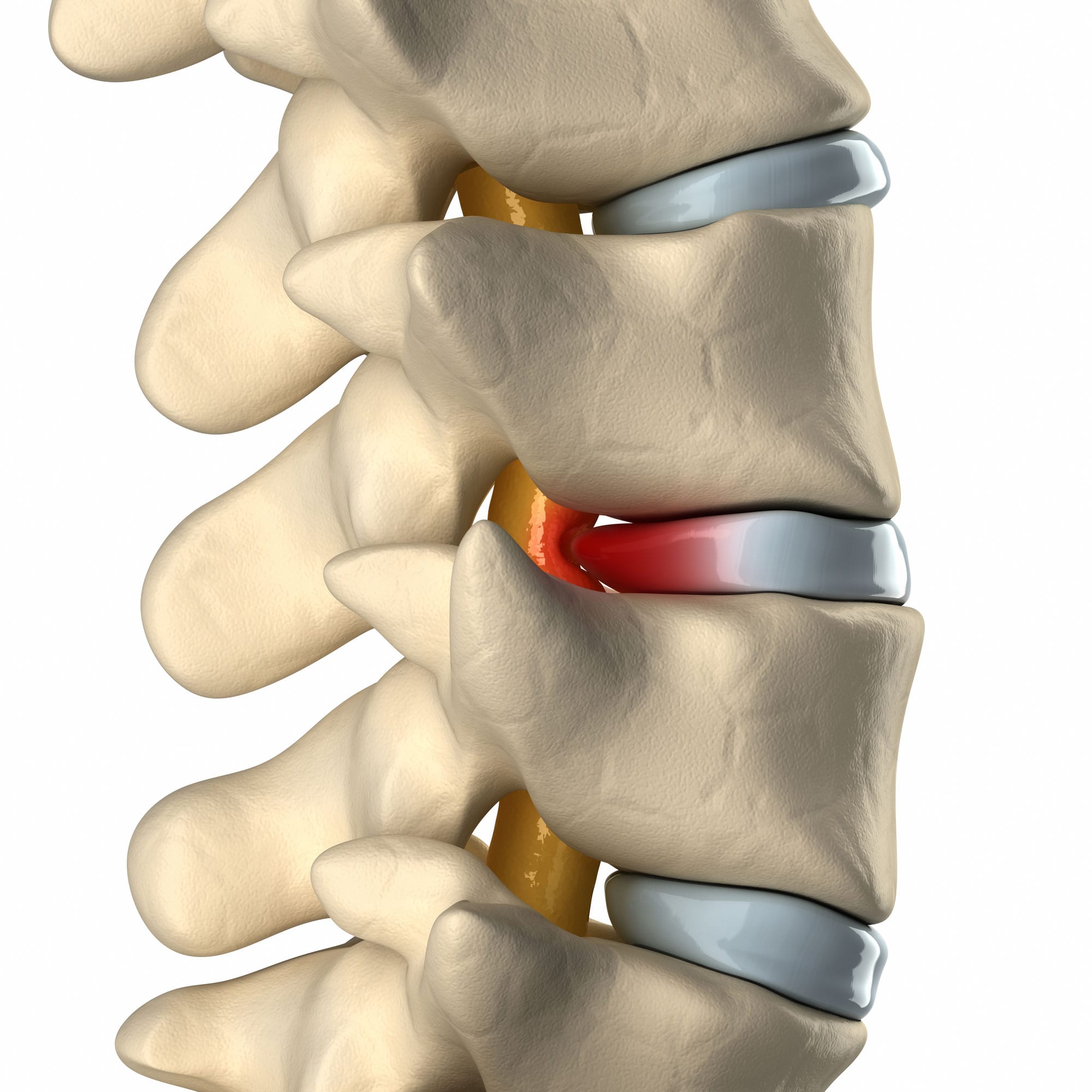 Spinal Herniated Disc - Clearcut Physiotherapy