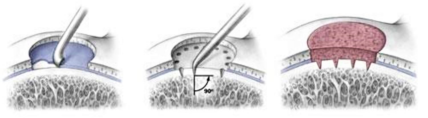 Microfracture Surgery - Motus Physical Therapy