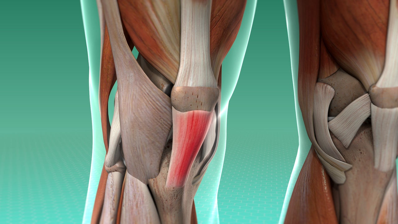 Тендинит коленных связок. Тинезит коленного сустава. Тендинит сухожилия подколенной мышцы. Тендинит тазобедренного сухожилия. Тандерид коленного сустава.