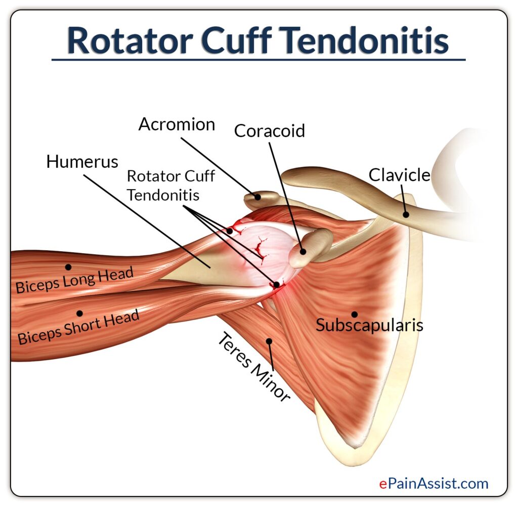 Rotator Cuff Tendonitis - Motus Physical Therapy