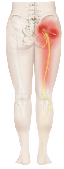 Piriformis Syndrome - Motus Physical Therapy